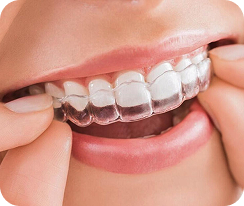 Niềng Răng - Chỉnh nha